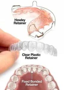 Different types of retainers